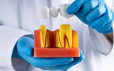 Smile with Confidence: How Long Will Your Dental Bridge Last?