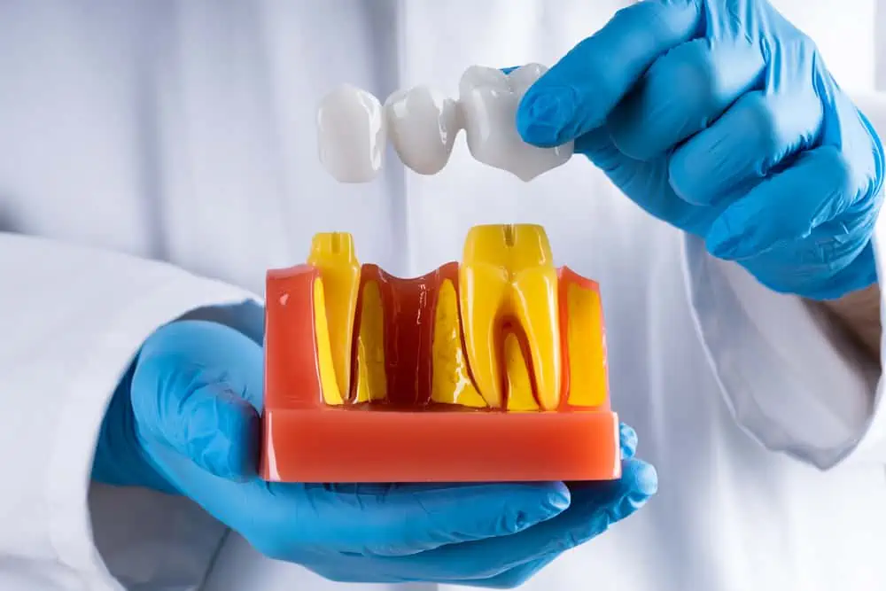 How Long Will Your Dental Bridge Last?
